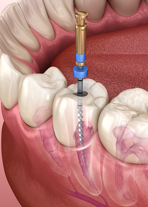 3D render showing the process of a tooth being drilled for a root canal treatment.